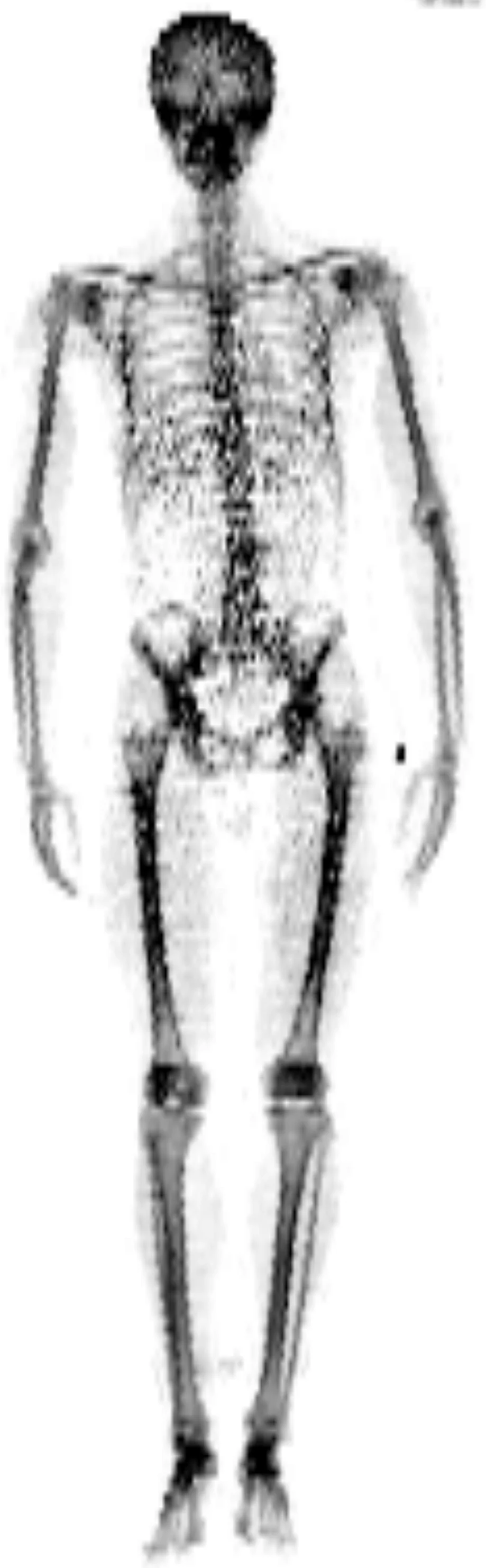 DEXA bone density skeletal scan showing full skeleton from posterior view