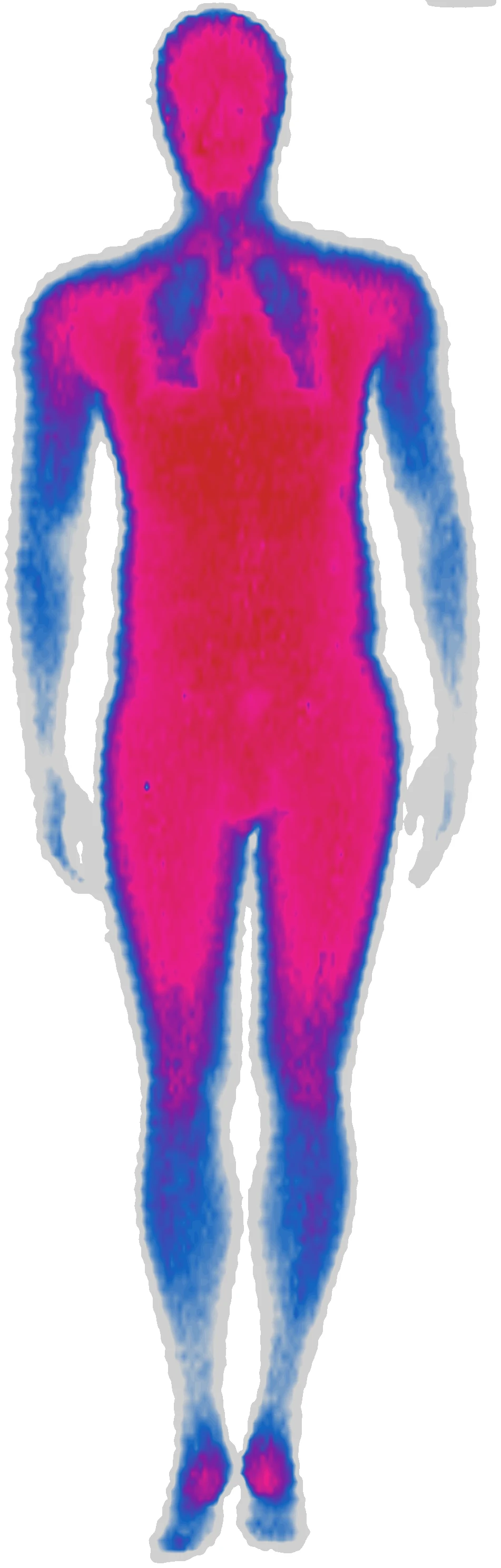 DEXA fat distribution heatmap — dense fat shown in pink/red, lean areas in blue
